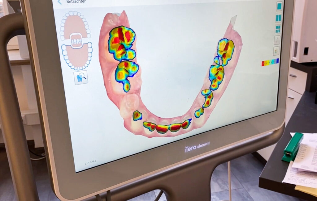 iTero digitaler Scan Zähne Biss Funktion Kiefergelenk Druckstellen